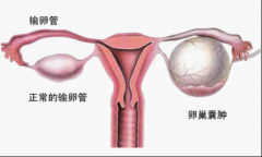 卵巢囊肿的症状有哪些